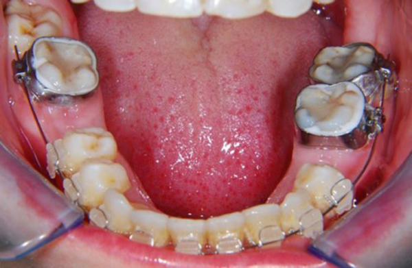 Mất răng hàm số 6 có niềng răng được không? tiêu xương hàm có niềng răng được không
