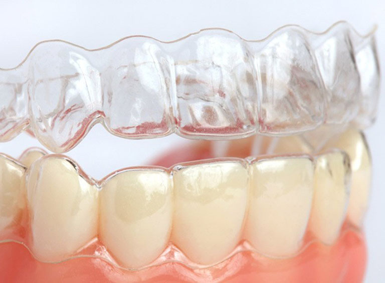 Niềng Răng 3D Clear Không Mắc Cài : Giá & Ưu nhược điểm