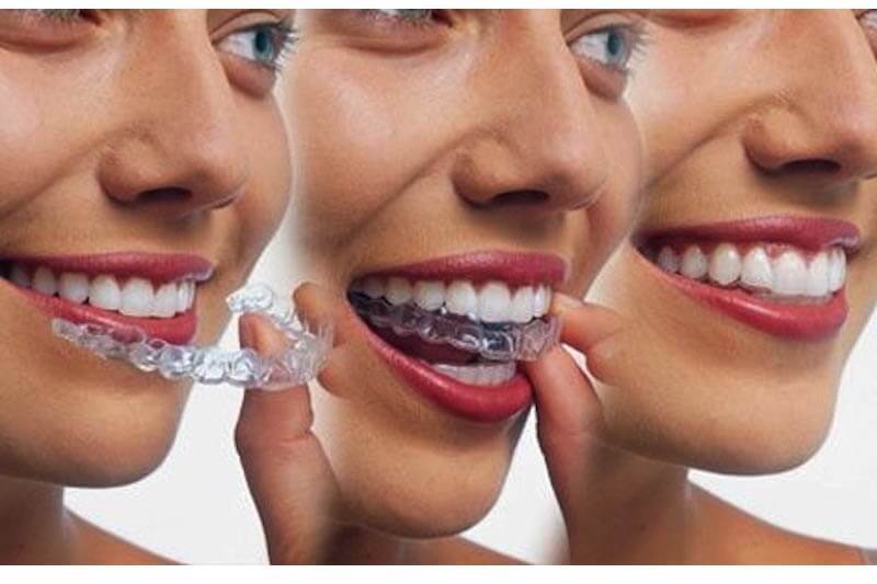 Niềng răng trong suốt mất bao lâu mới mang lại kết quả?