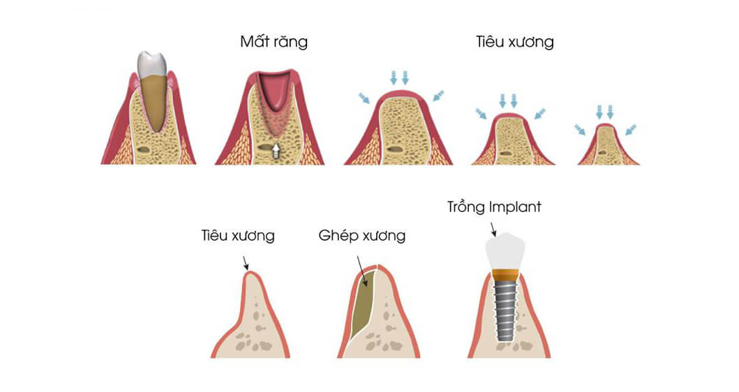 tiêu xương hàm có niềng răng được không - giải pháp điều trị