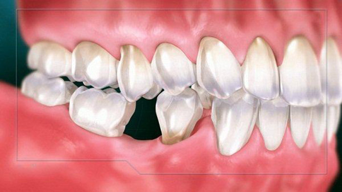 tiêu xương hàm có niềng răng được không? nguyên nhân