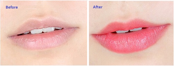 Hình ảnh trước và sau khi phun môi