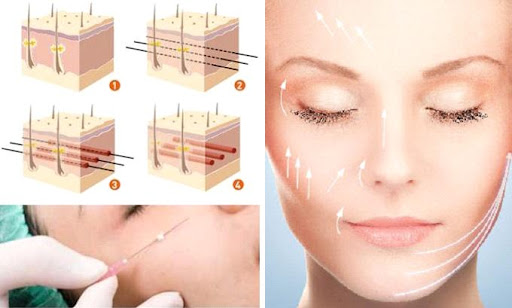 Top 4 phương pháp căng da mặt tốt nhất hiện nay