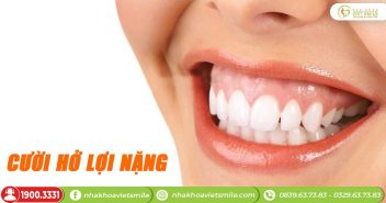 Cười hở lợi là gì? 4 phương pháp điều trị phổ biến hiện nay