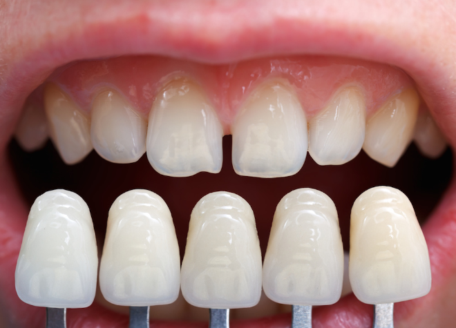Chuyên gia chia sẻ ưu và nhược điểm của răng sứ thẩm mỹ - 1