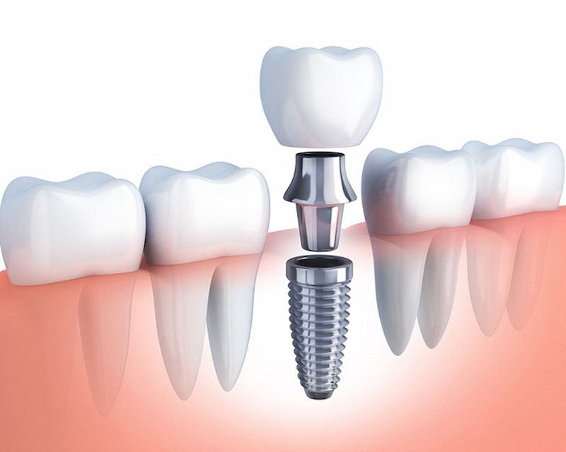 Trồng răng Implant có tốt không? Chi phí và địa chỉ cấy ghép uy tín