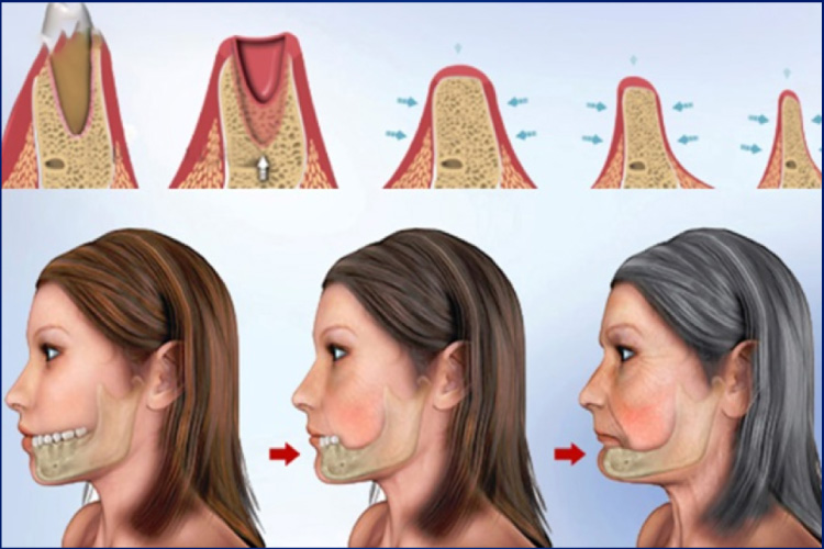 Quá trình tiêu xương hàm sau khi mất răng - tiêu xương hàm có niềng răng được không