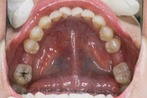 Mất Răng Số 6 Và 7 Có Niềng Được Không? Hậu Quả Việc Mất Răng Cối Lớn - tiêu xương hàm có niềng răng được không