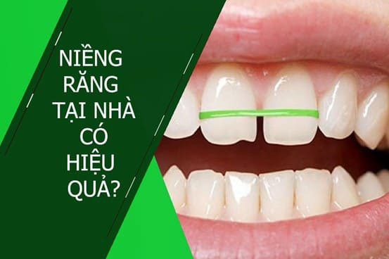 Niềng răng tại nhà