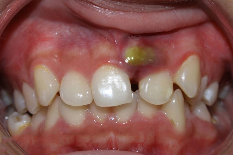 Niềng răng tại nhà có thể gây ra tình trạng viêm nhiễm nặng