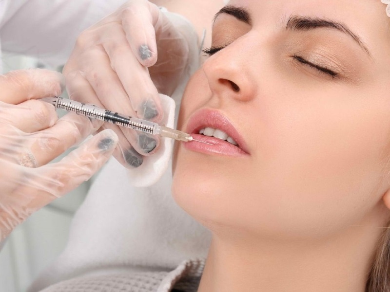 Tiêm Filler Môi – Tạo hình đôi môi đẹp, bờ môi quyến rũ