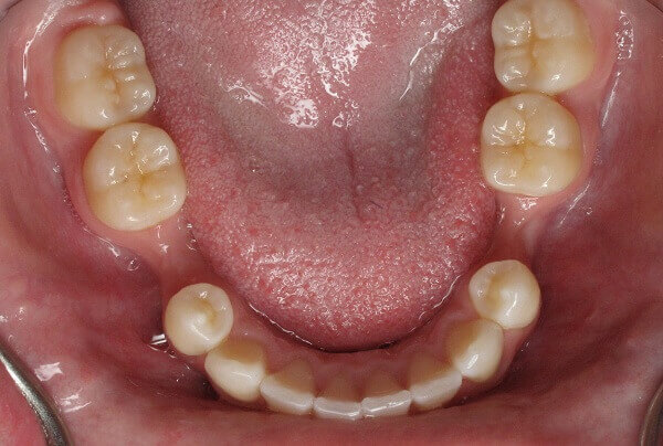 tiêu xương hàm có niềng răng được không - định nghĩa