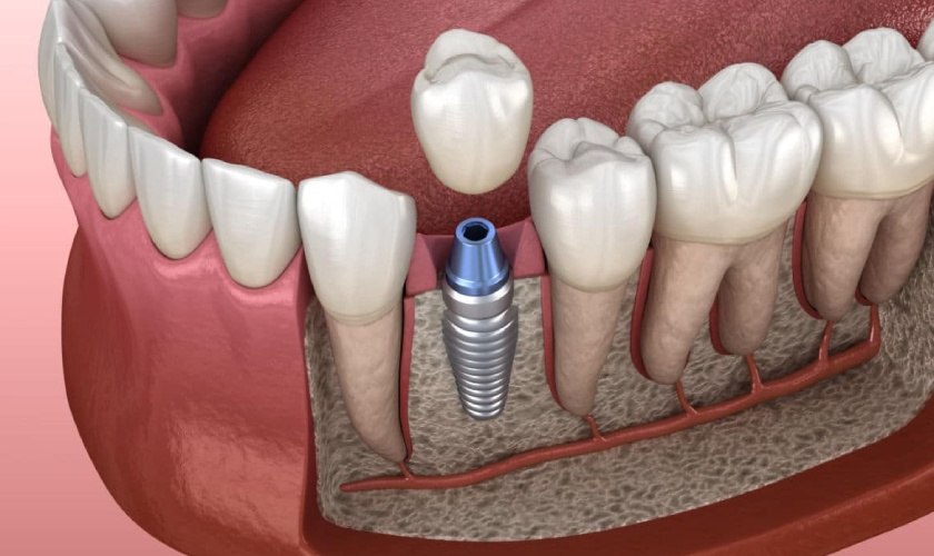 Trồng răng implant đơn lẻ